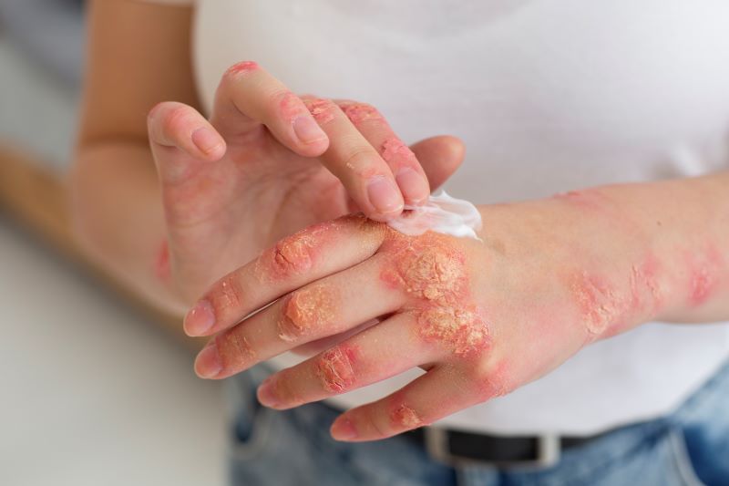 Seboroični dermatitis še ni popolnoma ozdravljiv