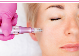 microneedling